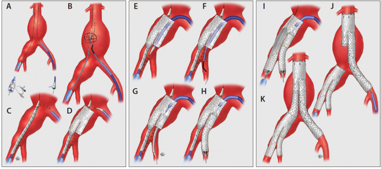 [의학용어/약어] IBD(Iliac branch device) 영상의학과 시술 : 네이버 블로그