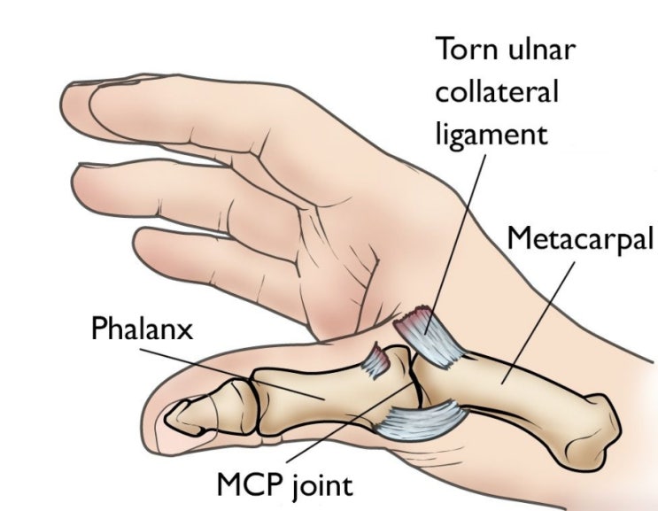 [OS수술] Thumb UCL(Ulnar Collateral Ligament) Repair : 네이버 블로그