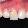 앞니 라미네이트 & 크라운, 신경치료를 통해 발치 진단 받은 치아 살리기 (치아사이충치+치열개선)