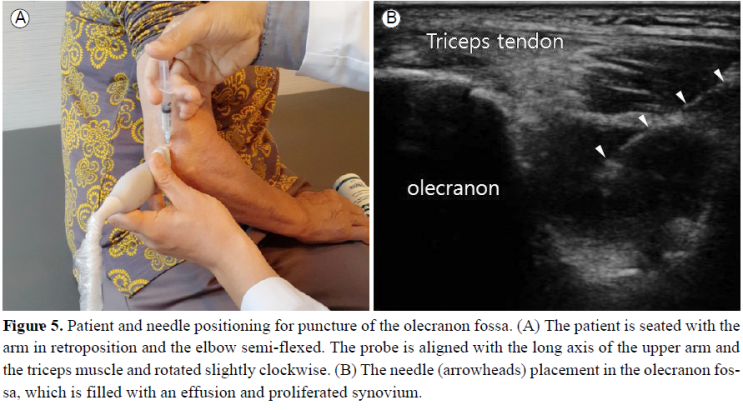 Elbow IA injection (US guided) : 네이버 블로그