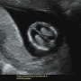 임신/ 대학병원 정밀초음파, 입체초음파, 12주 태아 뇌 작음, 22주 신장 크기, 배 물혹