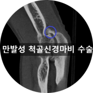 [부산 성가병원] 만발성 척골신경마비 환자분의 사례입니다.