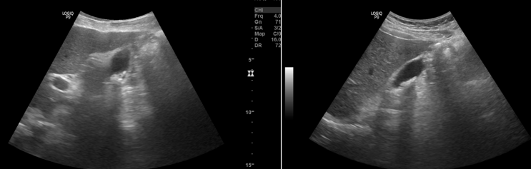 Sandy stones,GB sludge, 급성 담낭염(Acute cholecystitis) : 네이버 블로그