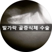[부산 성가병원] 발가락 골증식체 환자분의 수술 사례입니다.