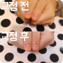 대구손톱교정 물어뜯는손톱 아름다운 변화!