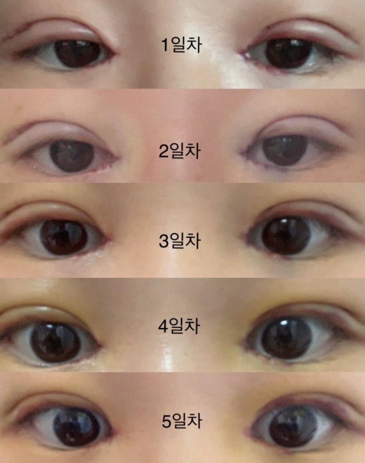 [쌍수 후기]1~5일차 절개, 앞트임, 눈매교정 후기 / 붓기 다 빠진 지금 눈 +재수술함 : 네이버 블로그
