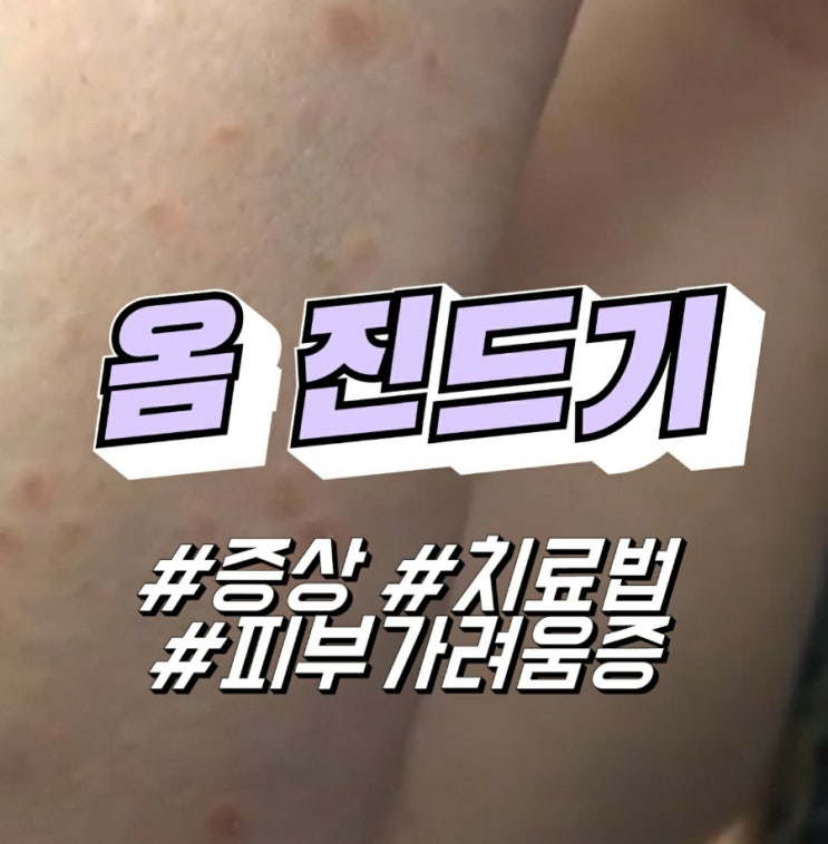 옴 진드기, 옴 증상 및 치료법 (손가락 사타구니 전신 피부 가려움증) : 네이버 블로그