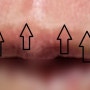 입술 보톡스 (윗입술 세로 주름 보톡스, 필러) 원리 및 효과, 부작용(입술 주름 생기는 이유) - 삼성동 피부과 전문의 닥터림