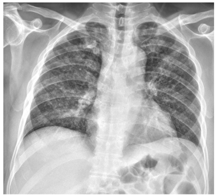 활동성 폐결핵 폐엑스레이 검사 증례, 속립결핵, 기관지확장증, Bronchiectasis, brochial wall ...