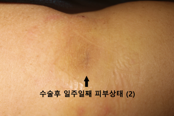 오래된 어깨 혹, 표피낭종 수술 녹는실 봉합, 2022년10월[레이디유외과] : 네이버 블로그