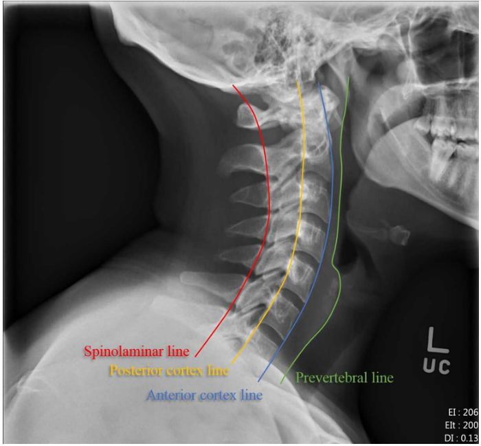  x ray feat 