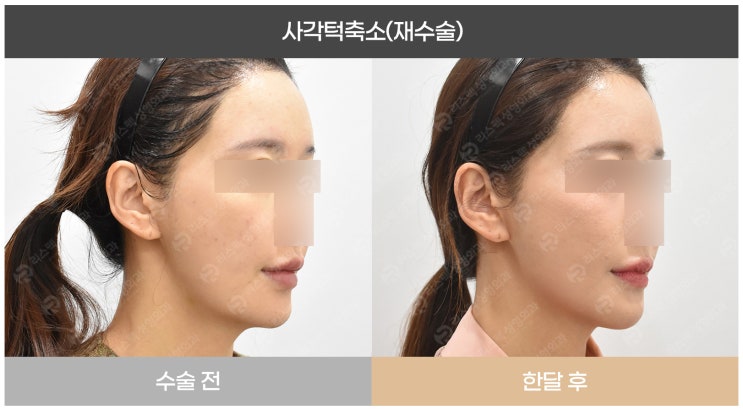 사각턱재수술(이차각제거), 사각턱축소 - 리스펙성형외과 김기웅원장 윤곽이야기 : 네이버 블로그