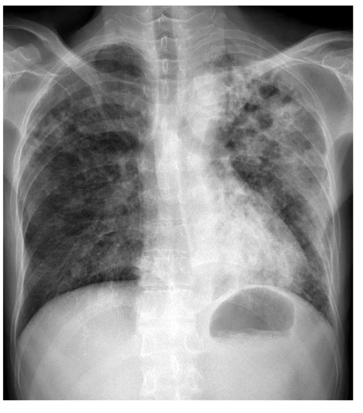 활동성 폐결핵 xray 검사 증례, 폐경결, 공동 : 네이버 블로그