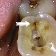 치료사례::금이 간 치아의 치료 ( 정기검진의 중요성 )