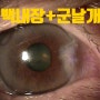 구래동 바른안과 김포백내장 수술( 군날개, 백내장 복합수술 )