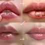 입술 고름 염증 구내염 치료 후기 (포진과 달라요 처방이 중요함 ㅠ)