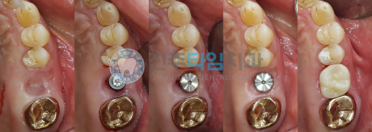 치아뿌리 끝 염증, 발치후 임플란트 #에스락임플란트 #SLOCK : 네이버 블로그