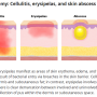 Stasis dermatitis vs cellulitis (of the lower extremities)