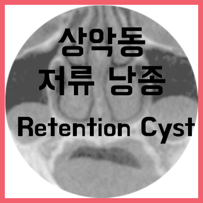 [코] 상악동 저류 낭종(Retention cyst) : 네이버 블로그