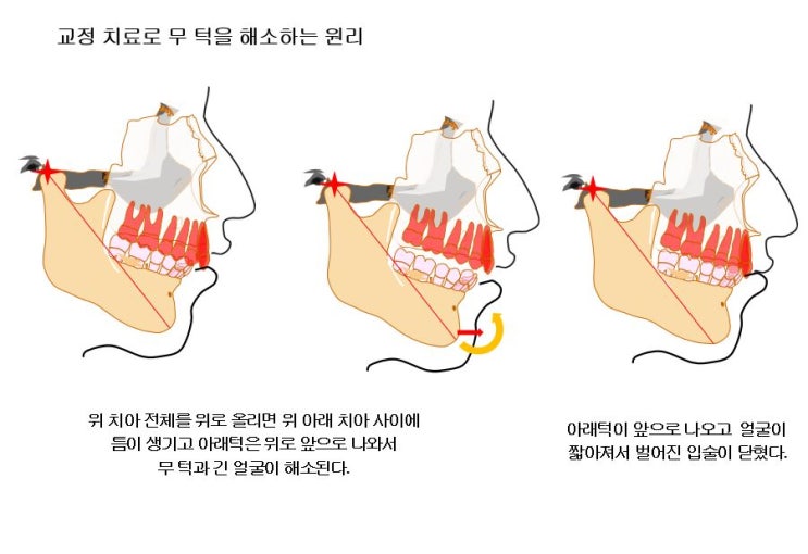 긴얼굴 무턱 돌출입의 교정치료 : 네이버 블로그