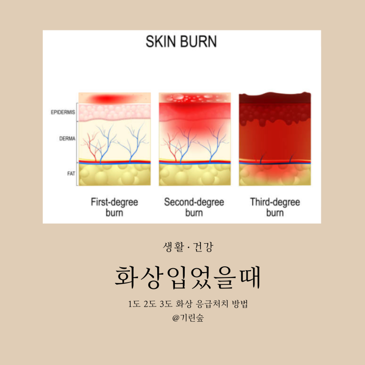 화상입었을때 1도 2도 3도 화상 응급처치 방법 : 네이버 블로그