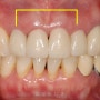 반투명 지르코니아를 이용하여 앞니의 심하게 변색된 치아를 치료한 증례