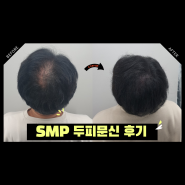 SMP 두피문신 후기 강남 원장님께 직접 시술 받은 리얼 찐 리뷰 추천, 원형 정수리 탈모 치료 고민 해결 모발이식 단점