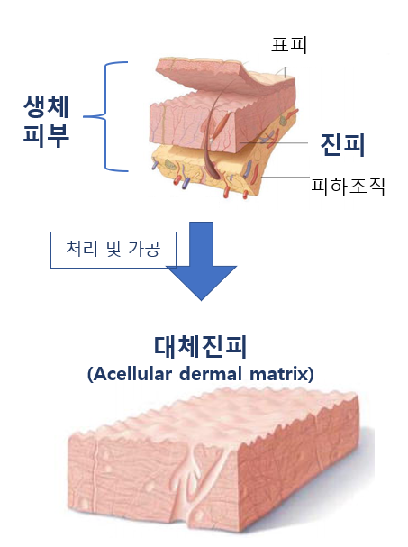 대체진피 확대수술을 하면 턱짐이 생기는 이유와 예방법 : 네이버 블로그