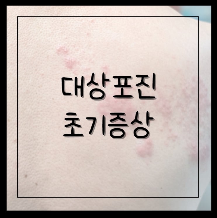 대상포진 초기증상 및 전염성 : 네이버 블로그
