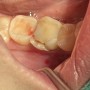 동천동 치과 치아파절로 인한 당일 발치 후 즉시식립 케이스
