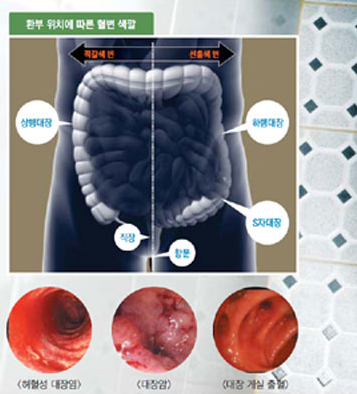 대변 피(피똥) 치질 때문? : 네이버 블로그