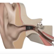 보청기 노출이 걱정된다면 ? 초소형 고막형 보청기(IIC)를 알아보세요.