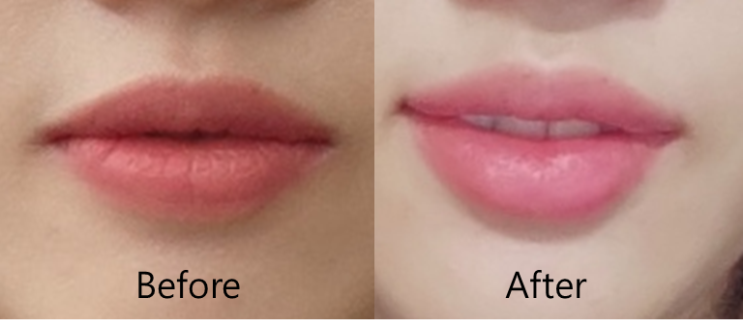 입꼬리 필러 & 입꼬리 보톡스 후기 : 네이버 블로그