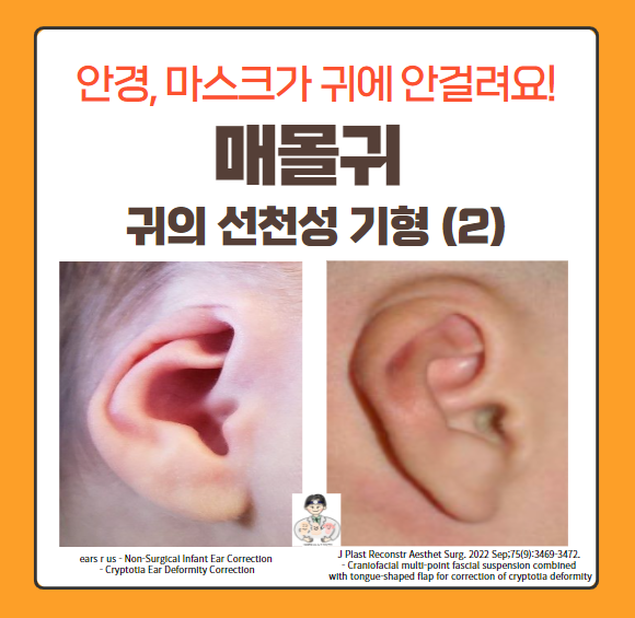 귀의 선천성 기형 (2) - 매몰귀(Cryptotia) : 네이버 블로그