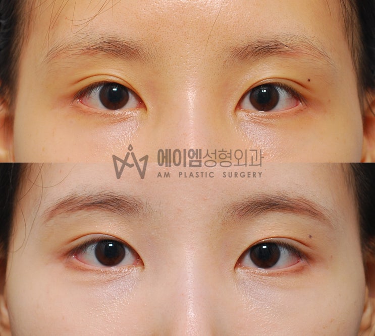 눈재수술 고찰 71. [두줄따기, 소세지눈, 매몰 풀기, 쌍커풀 없애는법 (쌍꺼풀), 속쌍 쌍수] : 네이버 블로그