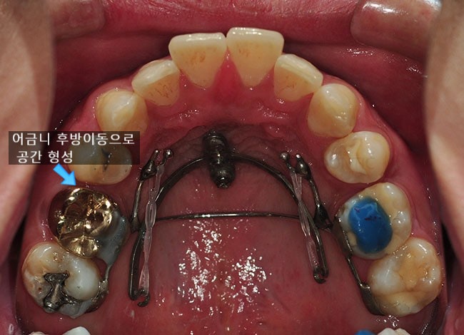 발치교정 후에도 남아 있는 치아돌출 교정방법 : 네이버 블로그