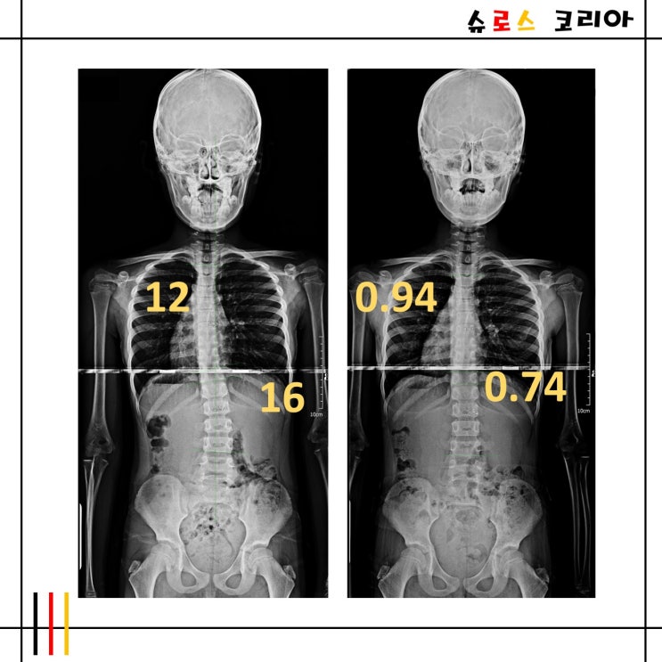 서울송파 슈로스척추측만전문센터 슈로스운동 척추측만 개선사례 - 흉추 12도 요추 16도 : 네이버 블로그