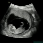 [2022.05.25 / 임신11주1일] 임신11주 초음파, 임산부 공황, 맥페란 부작용