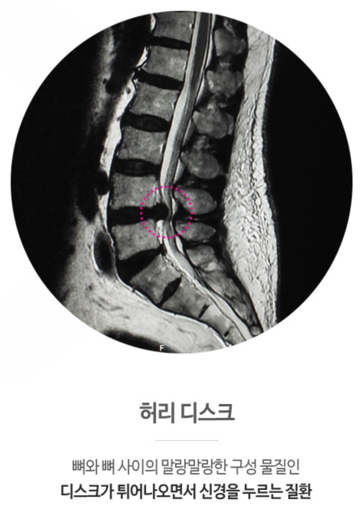 대전좌골신경통 원인을 정확히 감별해야 합니다 : 네이버 블로그