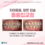 일산치과, 일산연치과 치료후기 - 치아돌출 및 얇은 입술의 돌출입교정