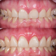 거미스마일 잇몸성형 - 재발없기 위해선 치조골성형 동반한 치관확장술(CLP) 동반하여, 선정릉역 치과