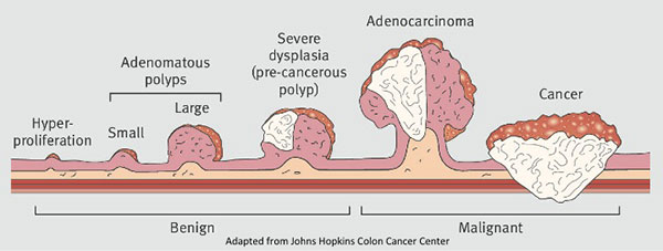 저도 이형성 선종(tubular adenoma low grade dysplasia)이란? : 네이버 블로그