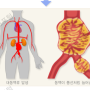 대동맥류 원인 5가지 & 주요증상 10가지