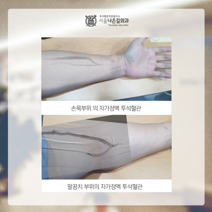 투석혈관은 얼마나 사용할 수 있나요? : 네이버 블로그