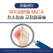 [경희중앙병원] 김해 무지외반증, 최소침습 교정절골술 MICA 장비 도입
