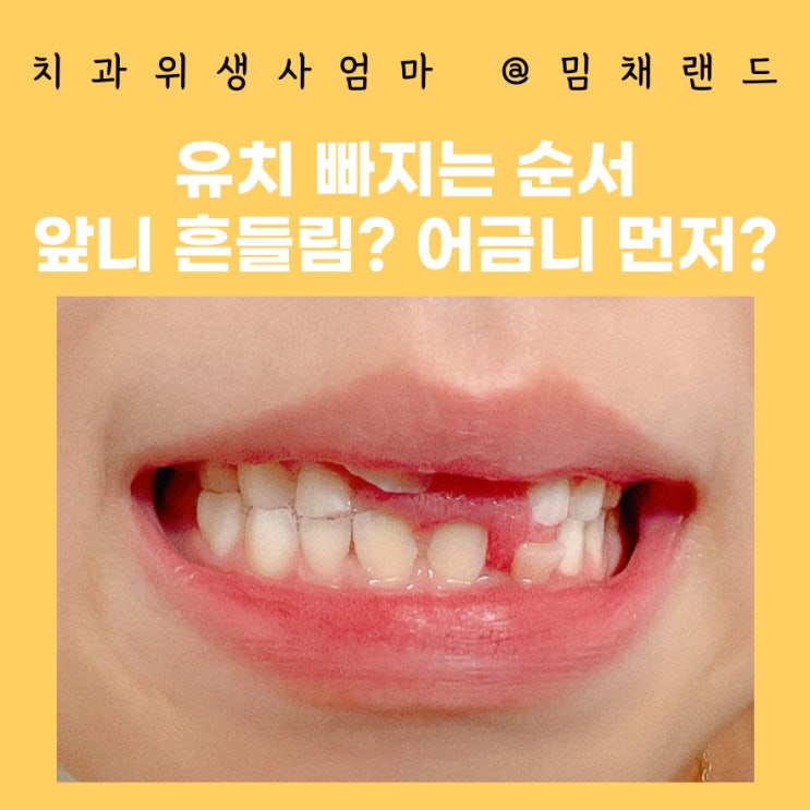 유치 빠지는 순서 앞니 치아 흔들림 어금니 나는 시기 : 네이버 블로그