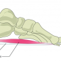 동통성 후족부 증후군 (Painful Heel Syndrome)