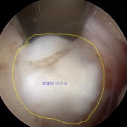 허리내시경 시술(수술)이란?_허리디스크치료 사례로 설명