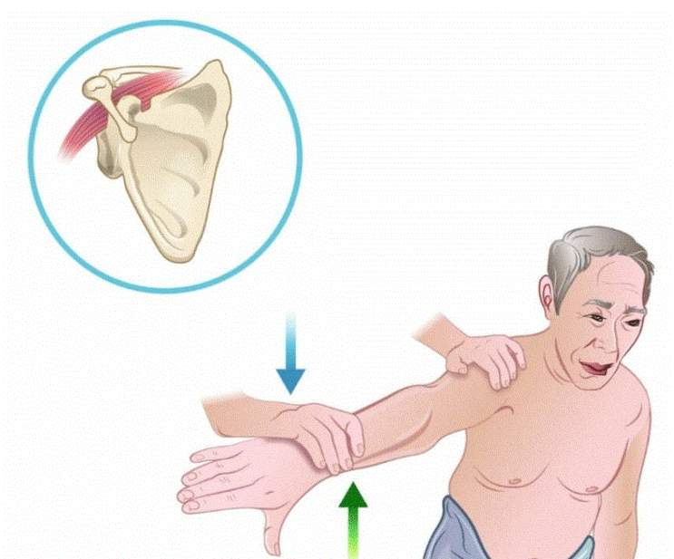 (플래티넘의원) 회전근개파열 증상에 맞춰 치료 하자!