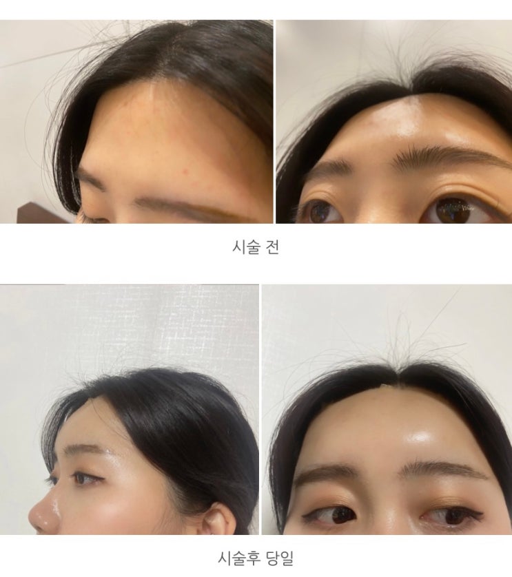 부산 센텀 자연스러운 이마필러 6cc 리얼 후기 (붓기 사진 / 멍 / 통증 / 정보공유) : 네이버 블로그 부산 센텀 자연스러운 이마필러 6Cc 리얼 후기 (붓기 사진 / 멍 / 통증 / 정보공유) : 네이버 블로그